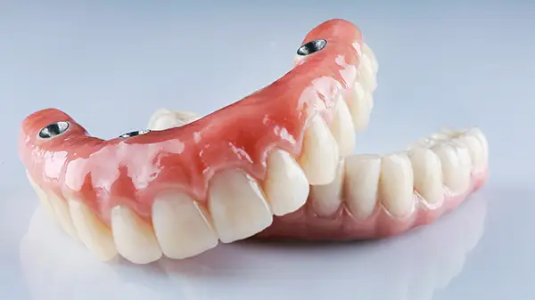Close-up view of upper and lower full-arch overdentures designed for secure tooth replacement.